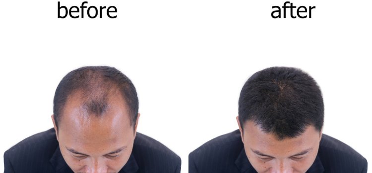 Saç Ekimi Sonrası İyileşme Süreci: Nelere Dikkat Edilmeli?